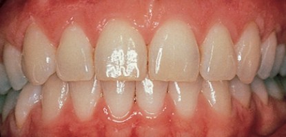 پیشگیری از بیماری پریودنتال دندان