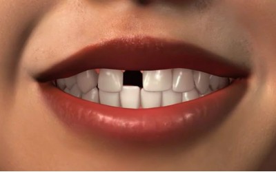 دندان مصنوعی برای کودکان